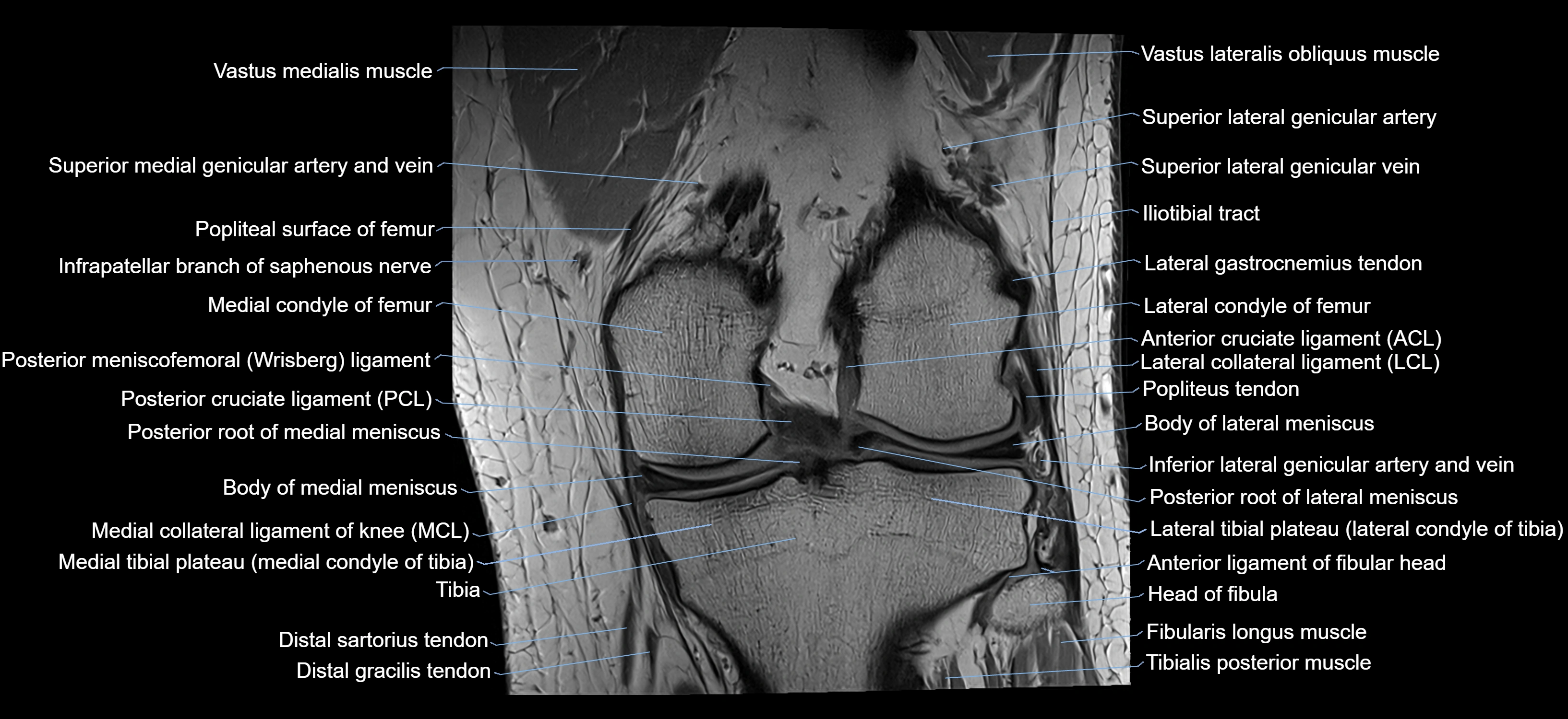 MRI knee coronal cross sectional anatomy labelled 3T radiology  image-04001-00024.webp